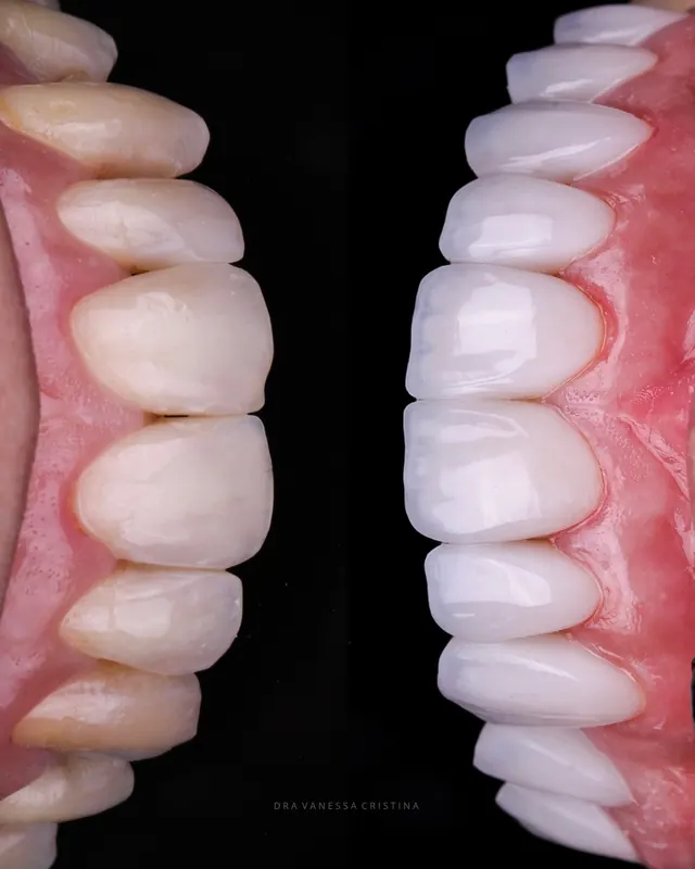 Antes e depois de facetas, lado a lado