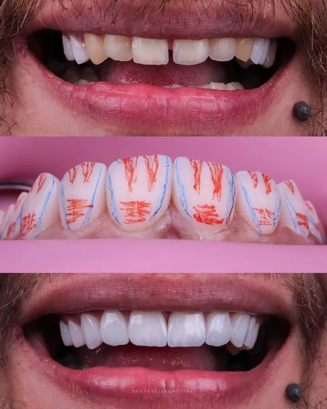 Sequência de um caso: dentes antes, dentes com marcações de planejamento e resultado final