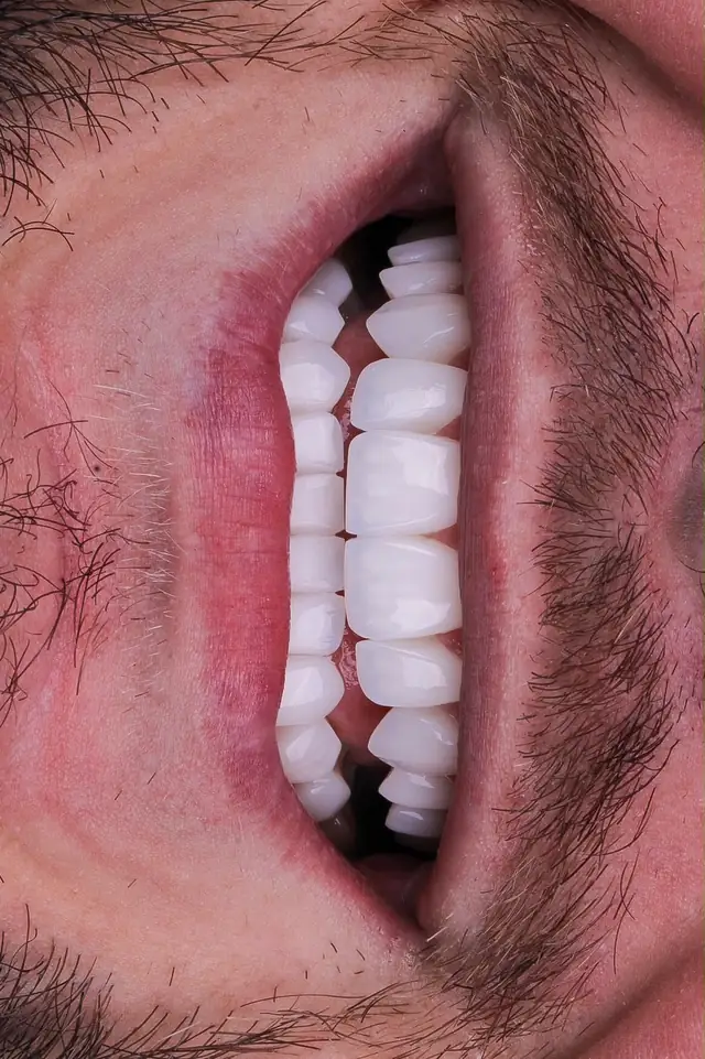 Sorriso masculino com lentes em resina, visto de perto